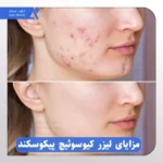 لیزر کیوسوئیچ پیکوسکند